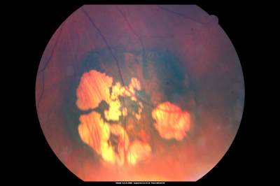 CHRPE lesion in the left eye - Irregular pigmentation
63 year old female with normal vision and CHRPE lesion in the right eye.
