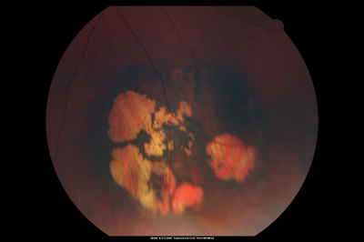 CHRPE lesion in the left eye - Irregular pigmentation
63 year old female with normal vision and CHRPE lesion in the right eye.
