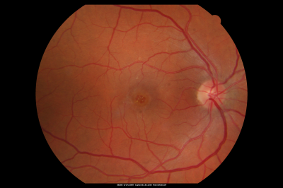 Macular Hole Closed with Vitrectomy - Preop
Keywords: macular hole; closed; vitrectomy