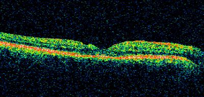 Macular Hole Closed with Vitrectomy - Post-op 20/60 Vision
Keywords: macular hole; closed; vitrectomy