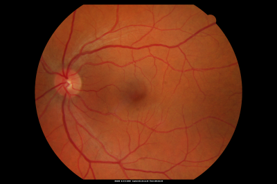 Macular Hole Closed with Vitrectomy - Preop
Keywords: macular hole; closed; vitrectomy