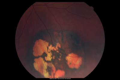CHRPE lesion in the left eye - Irregular pigmentation
63 year old female with normal vision and CHRPE lesion in the right eye.
