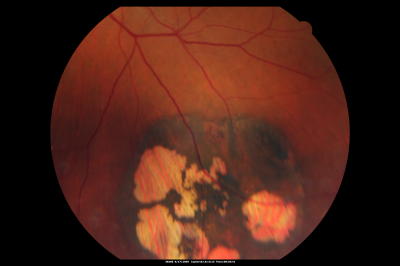 CHRPE lesion in the left eye - Irregular pigmentation
63 year old female with normal vision and CHRPE lesion in the right eye.
