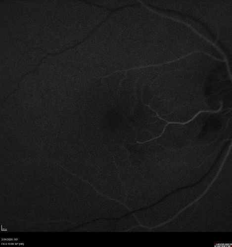Cilioretinal Artery Occlusion - Good vision
67 year old female - 5 days ago she was getting ready for bed and closed one eye (she had worked for an optometrist for 20 years) and she noticed a spot in the vision in the right eye and came in.  She has no focal neurological problems.  She once in a while gets some weakness.  She has a neurologist and there are some brain lesions.  Father had stroke at age 52.
VA OD: Dcc20/20 NccJ1
VA OS: Dcc20/16-2 NccJ1-2
