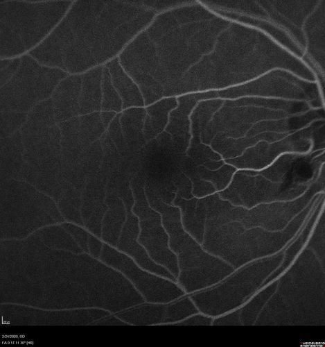 Cilioretinal Artery Occlusion - Good vision
67 year old female - 5 days ago she was getting ready for bed and closed one eye (she had worked for an optometrist for 20 years) and she noticed a spot in the vision in the right eye and came in.  She has no focal neurological problems.  She once in a while gets some weakness.  She has a neurologist and there are some brain lesions.  Father had stroke at age 52.
VA OD: Dcc20/20 NccJ1
VA OS: Dcc20/16-2 NccJ1-2
