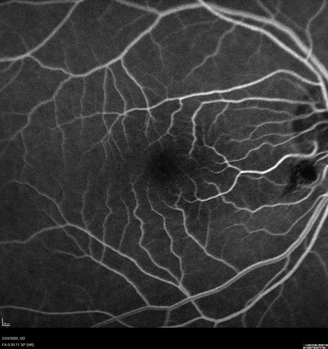 Cilioretinal Artery Occlusion - Good vision
67 year old female - 5 days ago she was getting ready for bed and closed one eye (she had worked for an optometrist for 20 years) and she noticed a spot in the vision in the right eye and came in.  She has no focal neurological problems.  She once in a while gets some weakness.  She has a neurologist and there are some brain lesions.  Father had stroke at age 52.
VA OD: Dcc20/20 NccJ1
VA OS: Dcc20/16-2 NccJ1-2
