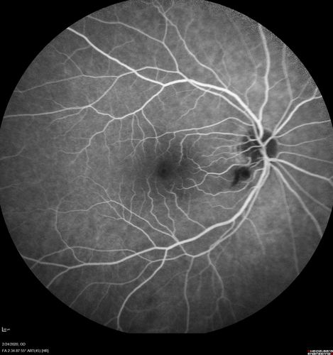 Cilioretinal Artery Occlusion - Good vision
67 year old female - 5 days ago she was getting ready for bed and closed one eye (she had worked for an optometrist for 20 years) and she noticed a spot in the vision in the right eye and came in.  She has no focal neurological problems.  She once in a while gets some weakness.  She has a neurologist and there are some brain lesions.  Father had stroke at age 52.
VA OD: Dcc20/20 NccJ1
VA OS: Dcc20/16-2 NccJ1-2
