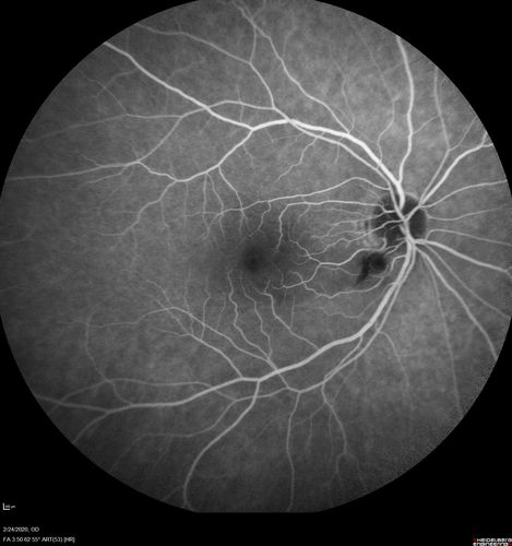 Cilioretinal Artery Occlusion - Good vision
67 year old female - 5 days ago she was getting ready for bed and closed one eye (she had worked for an optometrist for 20 years) and she noticed a spot in the vision in the right eye and came in.  She has no focal neurological problems.  She once in a while gets some weakness.  She has a neurologist and there are some brain lesions.  Father had stroke at age 52.
VA OD: Dcc20/20 NccJ1
VA OS: Dcc20/16-2 NccJ1-2
