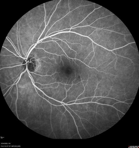 Cilioretinal Artery Occlusion - Good vision
67 year old female - 5 days ago she was getting ready for bed and closed one eye (she had worked for an optometrist for 20 years) and she noticed a spot in the vision in the right eye and came in.  She has no focal neurological problems.  She once in a while gets some weakness.  She has a neurologist and there are some brain lesions.  Father had stroke at age 52.
VA OD: Dcc20/20 NccJ1
VA OS: Dcc20/16-2 NccJ1-2
