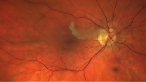 cilioretinalarteryocclusion_dosih_20191230_01~0.png