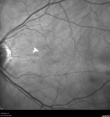 Cilioretinal Artery Occlusion - non central
81 year old female She noticed sudden vision loss in the right eye just before Christmas while watching television.Â  This was about one week ago.Â  She noticed when she closed her left eye and looked out of her right eye there was a darkness in the vision.Â  The left eye is OK.Â  She has no history of stroke and no neurological problems.Â  She had a few headaches recently but they went away.Â Â 
PMHx: HTN, Breast Cancer 
Meds: HCTZ, Atorvastatin, Atenolol, Anastrozole
VA 20/80 OD, 20/32 OS

VA improved to 20/40 in one month in the involved eye

