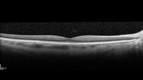 cilioretinalarteryocclusion_dosih_20191230_05~0.jpg