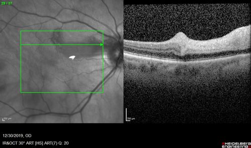 cilioretinalarteryocclusion_dosih_20191230_07~0.jpg