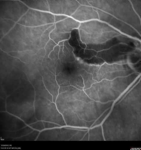 cilioretinalarteryocclusion_dosih_20191230_13.jpg