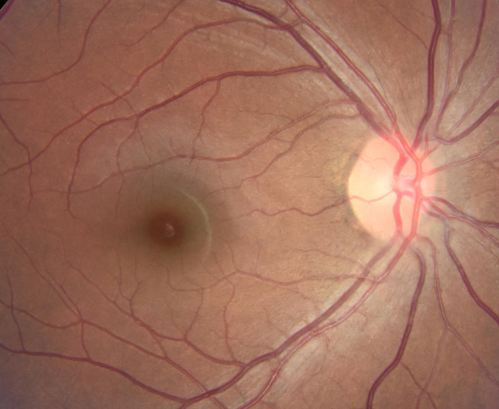 Toxoplasmosis - Recurrent - Moderate Vitritis
32 year old woman with 20/80 vision and moderately painful red eye in the left eye only.  The left eye had some redness about 10 years ago.  She is a native of Sierra Leone
