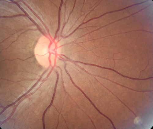 Toxoplasmosis - Recurrent - Moderate Vitritis
32 year old woman with 20/80 vision and moderately painful red eye in the left eye only.  The left eye had some redness about 10 years ago.  She is a native of Sierra Leone
