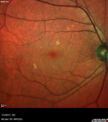 Travatan Induced CME Left eye
63 year old woman 4 years post ECCE and 2 years post PPV for floaters.  She developed CME in the left eye after 1 year of travatan.  The travatan was stopped and the CME and serous retinal detachment resolved.
