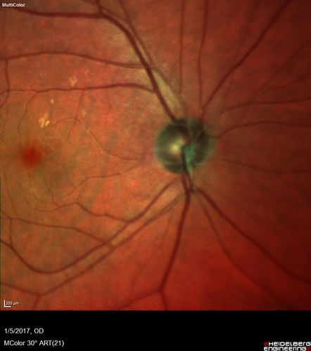 Travatan Induced CME Left eye
63 year old woman 4 years post ECCE and 2 years post PPV for floaters.  She developed CME in the left eye after 1 year of travatan.  The travatan was stopped and the CME and serous retinal detachment resolved.
