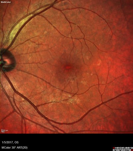 Travatan Induced CME Left eye
63 year old woman 4 years post ECCE and 2 years post PPV for floaters.  She developed CME in the left eye after 1 year of travatan.  The travatan was stopped and the CME and serous retinal detachment resolved.

