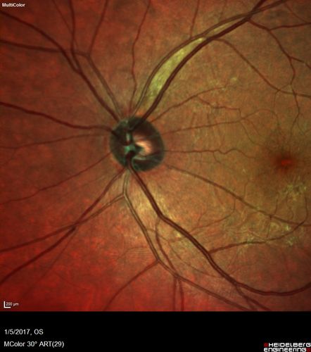 Travatan Induced CME Left eye
63 year old woman 4 years post ECCE and 2 years post PPV for floaters.  She developed CME in the left eye after 1 year of travatan.  The travatan was stopped and the CME and serous retinal detachment resolved.
