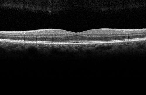 Travatan Induced CME Left eye
63 year old woman 4 years post ECCE and 2 years post PPV for floaters.  She developed CME in the left eye after 1 year of travatan.  The travatan was stopped and the CME and serous retinal detachment resolved.
