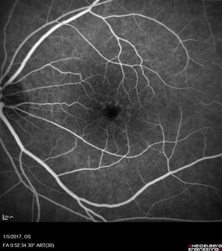 Travatan Induced CME Left eye
63 year old woman 4 years post ECCE and 2 years post PPV for floaters.  She developed CME in the left eye after 1 year of travatan.  The travatan was stopped and the CME and serous retinal detachment resolved.

