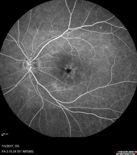 Travatan Induced CME Left eye
63 year old woman 4 years post ECCE and 2 years post PPV for floaters.  She developed CME in the left eye after 1 year of travatan.  The travatan was stopped and the CME and serous retinal detachment resolved.
