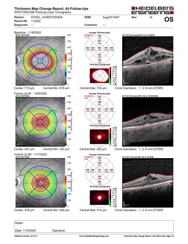 Pseudophakic CME chronic
74 year old man presented 14 weeks after cataract surgery with severe CME on topical therapy.  Multiple attempts to taper drops failed.  Also, the patient had a steroid responsive glaucoma.  He ended up on BID PF, Ketorolac and Dorz/Timolol
