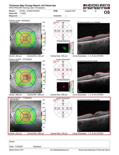 Pseudophakic CME chronic
74 year old man presented 14 weeks after cataract surgery with severe CME on topical therapy.  Multiple attempts to taper drops failed.  Also, the patient had a steroid responsive glaucoma.  He ended up on BID PF, Ketorolac and Dorz/Timolol
