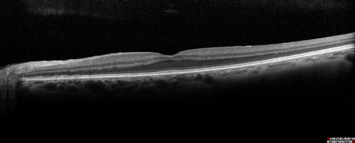 Travatan Induced CME Left eye - 1 month post stopping travatan CME is gone
63 year old woman 4 years post ECCE and 2 years post PPV for floaters.  She developed CME in the left eye after 1 year of travatan.  The travatan was stopped and the CME and serous retinal detachment resolved.
