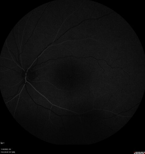 Pseudophakic CME chronic
74 year old man presented 14 weeks after cataract surgery with severe CME on topical therapy.  Multiple attempts to taper drops failed.  Also, the patient had a steroid responsive glaucoma.  He ended up on BID PF, Ketorolac and Dorz/Timolol
