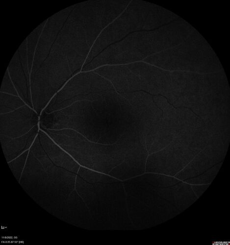 Pseudophakic CME chronic
74 year old man presented 14 weeks after cataract surgery with severe CME on topical therapy.  Multiple attempts to taper drops failed.  Also, the patient had a steroid responsive glaucoma.  He ended up on BID PF, Ketorolac and Dorz/Timolol

