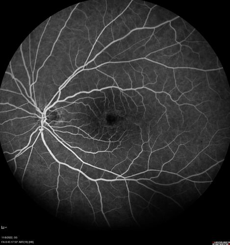 Pseudophakic CME chronic
74 year old man presented 14 weeks after cataract surgery with severe CME on topical therapy.  Multiple attempts to taper drops failed.  Also, the patient had a steroid responsive glaucoma.  He ended up on BID PF, Ketorolac and Dorz/Timolol
