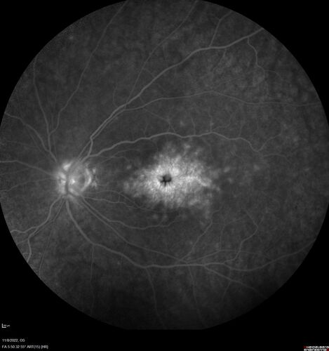 Pseudophakic CME chronic
74 year old man presented 14 weeks after cataract surgery with severe CME on topical therapy.  Multiple attempts to taper drops failed.  Also, the patient had a steroid responsive glaucoma.  He ended up on BID PF, Ketorolac and Dorz/Timolol
