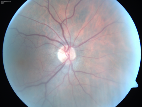 Pseudophakic Cystoid Macular Edema Both Eyes
81 year old man with vision loss about 4 months following ECCE.  Did not respond to topical therapy but did fine with PST kenalog
