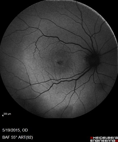 Pseudophakic Cystoid Macular Edema Both Eyes
81 year old man with vision loss about 4 months following ECCE.  Did not respond to topical therapy but did fine with PST kenalog
