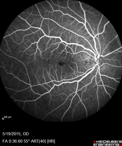 Pseudophakic Cystoid Macular Edema Both Eyes
81 year old man with vision loss about 4 months following ECCE.  Did not respond to topical therapy but did fine with PST kenalog
