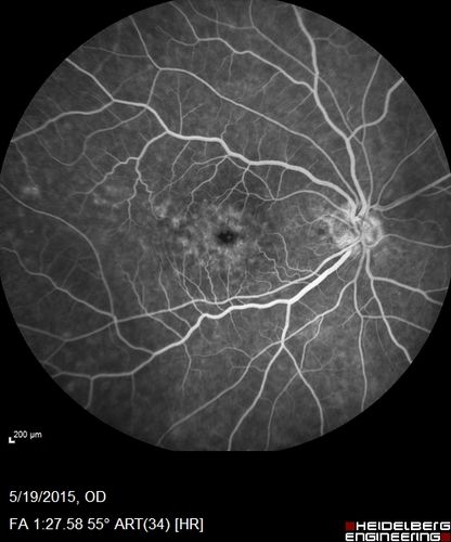 Pseudophakic Cystoid Macular Edema Both Eyes
81 year old man with vision loss about 4 months following ECCE.  Did not respond to topical therapy but did fine with PST kenalog
