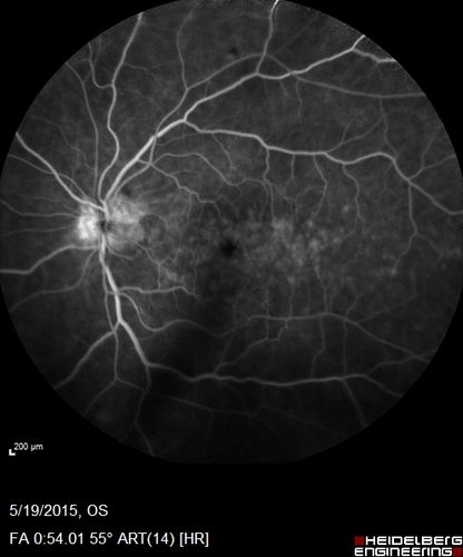 Pseudophakic Cystoid Macular Edema Both Eyes
81 year old man with vision loss about 4 months following ECCE.  Did not respond to topical therapy but did fine with PST kenalog
