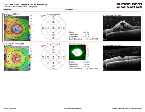 Cystoid Macular Edema 10 years after Cataract Surgery
No overt uveitis but the patient had aching in the eyes and responded to topical anti-inflammatory drops with recurrence of the CME on discontinuation of topical therapy

