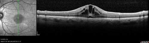 Cystoid Macular Edema 10 years after Cataract Surgery
No overt uveitis but the patient had aching in the eyes and responded to topical anti-inflammatory drops with recurrence of the CME on discontinuation of topical therapy
