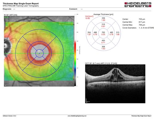 Cystoid Macular Edema 10 years after Cataract Surgery
No overt uveitis but the patient had aching in the eyes and responded to topical anti-inflammatory drops with recurrence of the CME on discontinuation of topical therapy
