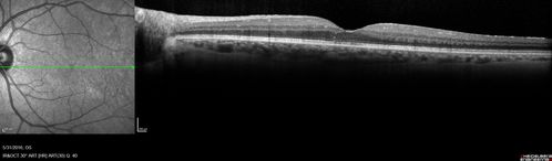 Cystoid Macular Edema 10 years after Cataract Surgery
No overt uveitis but the patient had aching in the eyes and responded to topical anti-inflammatory drops with recurrence of the CME on discontinuation of topical therapy
