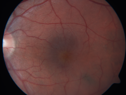 Cystoid Macular Edema 10 years after Cataract Surgery
No overt uveitis but the patient had aching in the eyes and responded to topical anti-inflammatory drops with recurrence of the CME on discontinuation of topical therapy
