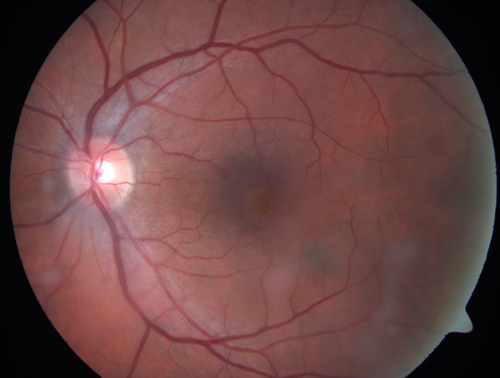 Cystoid Macular Edema 10 years after Cataract Surgery
No overt uveitis but the patient had aching in the eyes and responded to topical anti-inflammatory drops with recurrence of the CME on discontinuation of topical therapy
