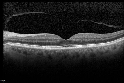 Cystoid Macular Edema following Cataract surgery and vitrectomy for floaters
73 year old woman who had decreased vision 4 months following combined vitrectomy and cataract surgery.  VA 20/63 improved in 1 month to 20/25 with ketorolac and prednisolone drops.
