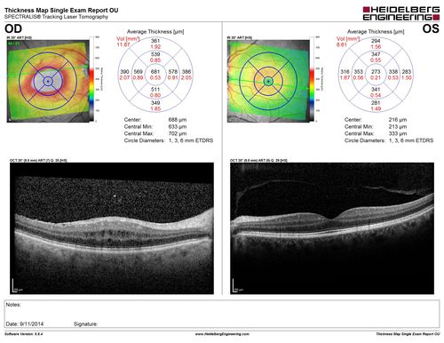 Cystoid Macular Edema following Cataract surgery and vitrectomy for floaters
73 year old woman who had decreased vision 4 months following combined vitrectomy and cataract surgery.  VA 20/63 improved in 1 month to 20/25 with ketorolac and prednisolone drops.
