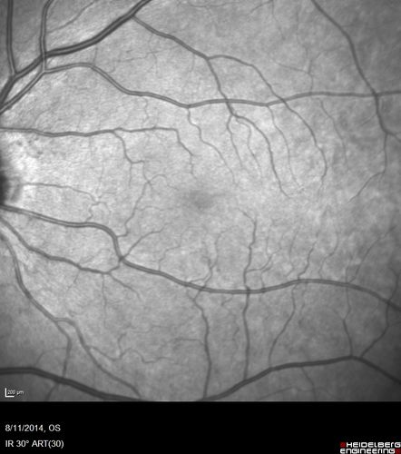 Cystoid Macular Edema following Cataract surgery and vitrectomy for floaters
73 year old woman who had decreased vision 4 months following combined vitrectomy and cataract surgery.  VA 20/63 improved in 1 month to 20/25 with ketorolac and prednisolone drops.
