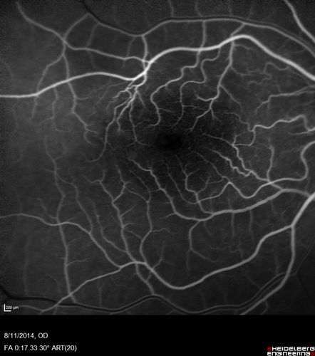Cystoid Macular Edema following Cataract surgery and vitrectomy for floaters
73 year old woman who had decreased vision 4 months following combined vitrectomy and cataract surgery.  VA 20/63 improved in 1 month to 20/25 with ketorolac and prednisolone drops.

