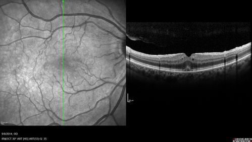 Cystoid Macular Edema following Cataract surgery and vitrectomy for floaters
73 year old woman who had decreased vision 4 months following combined vitrectomy and cataract surgery.  VA 20/63 improved in 1 month to 20/25 with ketorolac and prednisolone drops.
